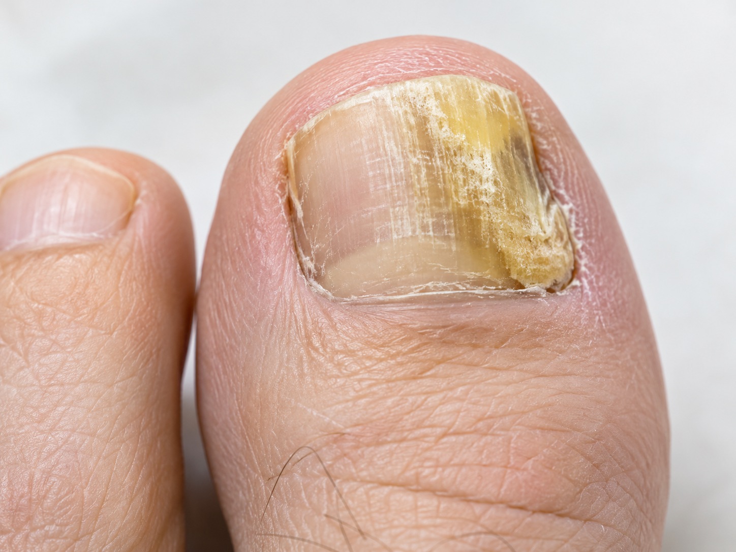 Onicomicosis